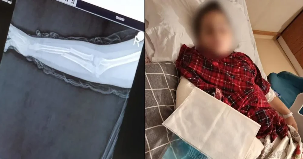 Okulda Akran Zorbalığı: 9 Yaşındaki Çocuk Arkadaşının Kolunu Kırdı, Ağır Yaralandı