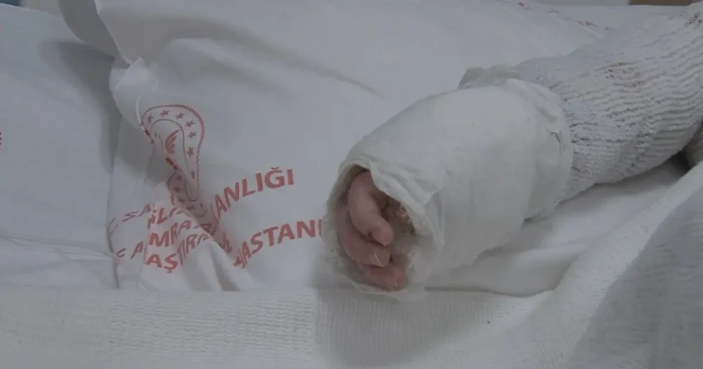 20 Aylık Bebek Sıcak Su Kazası Sonrası Sağlığına Kavuştu
