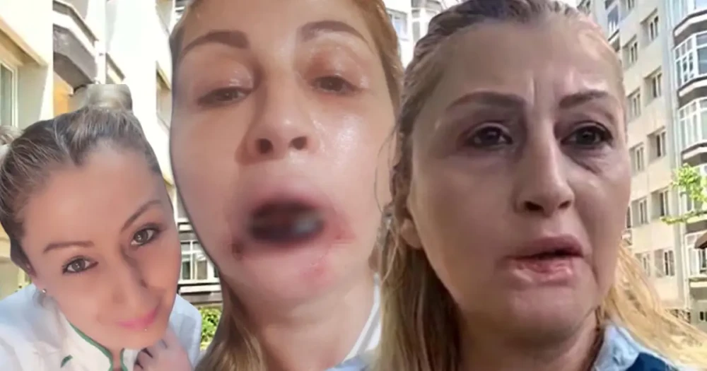 Dolgu Yaptırdığı Dudağı Çürüdü: Gülüşüm Yok, Yemek Yiyemiyorum